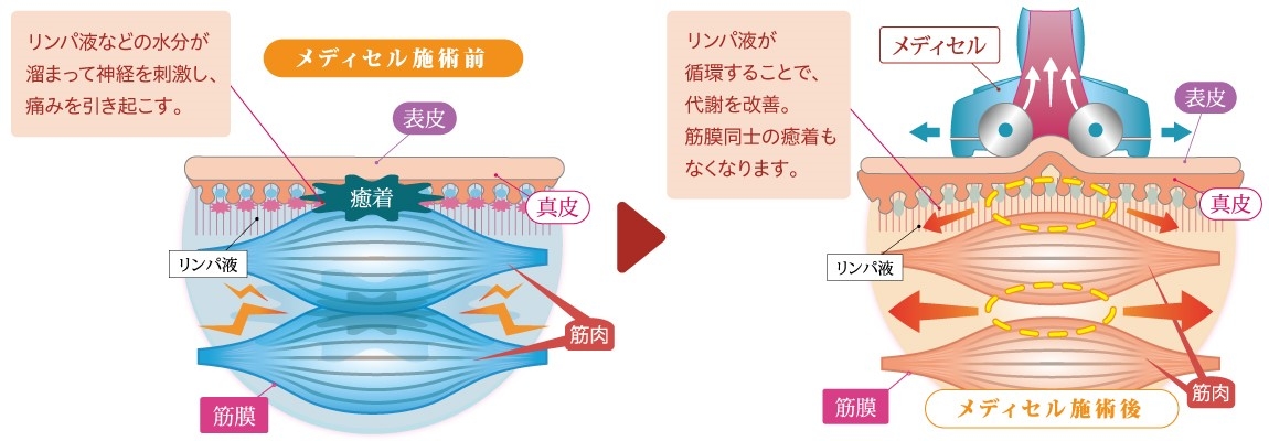 メディセル療法